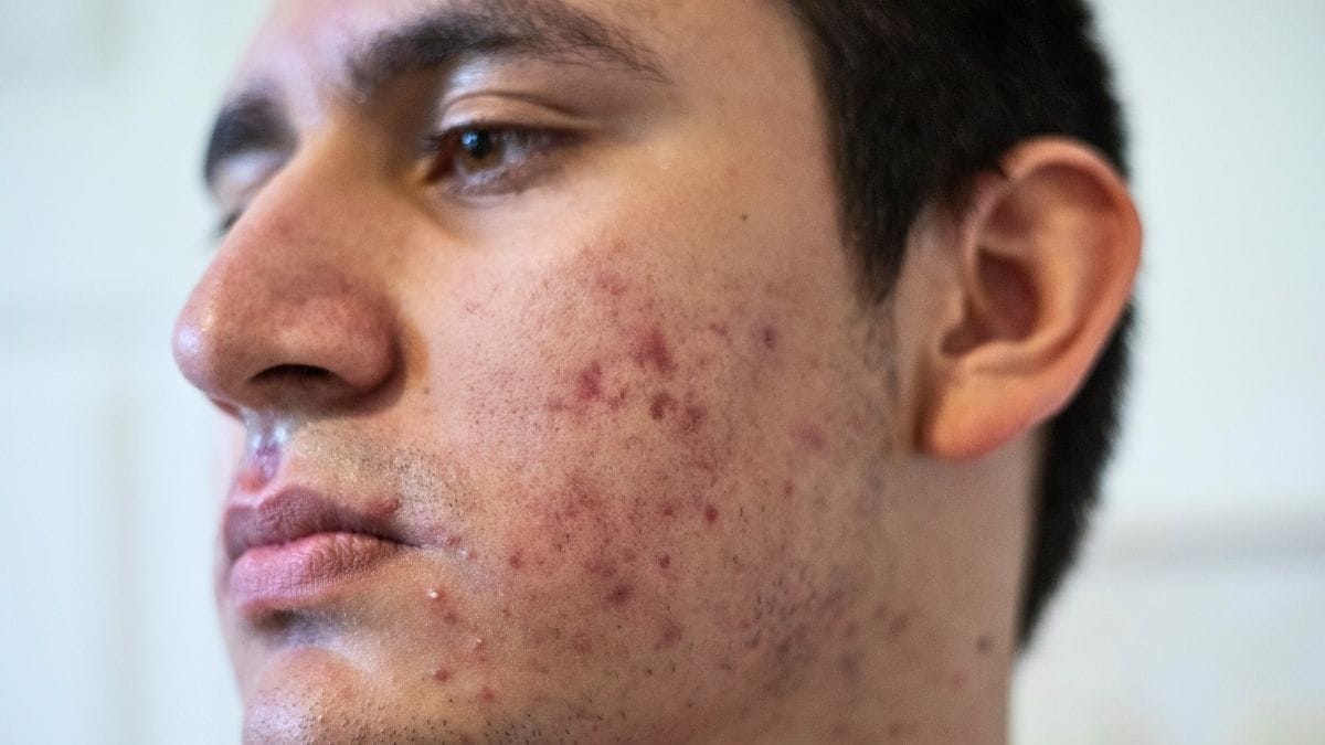 5-Day Acne-Friendly Meal Plan: Real Meals That May Support Clearer Skin